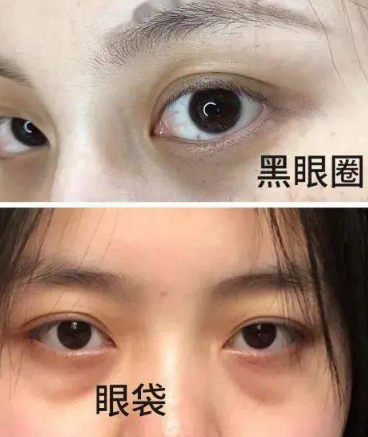 眼袋
