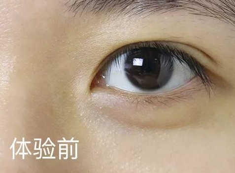 眼袋