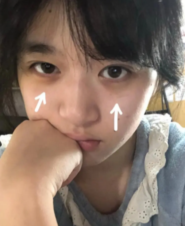 眼袋