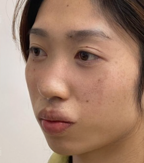 去眼袋手术