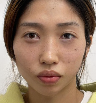 去眼袋手术