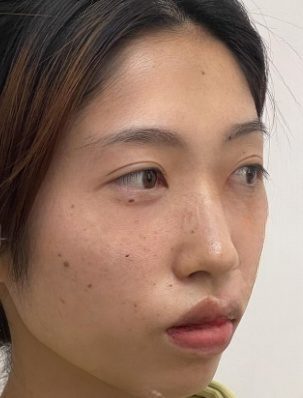 去眼袋手术