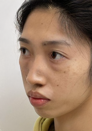 去眼袋手术
