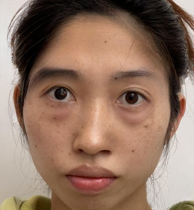 去眼袋手术