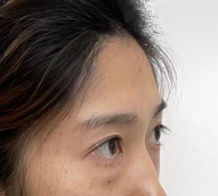 去眼袋手术