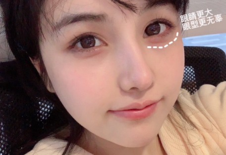 泪沟填充