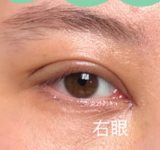 双眼皮修复