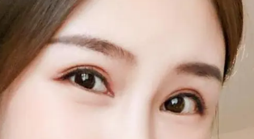 双眼皮修复