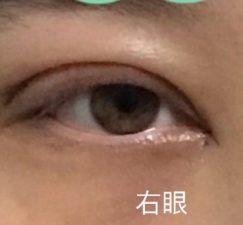 双眼皮修复