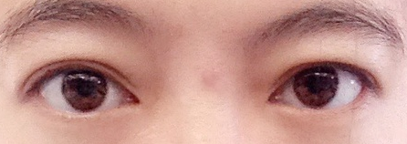 双眼皮修复
