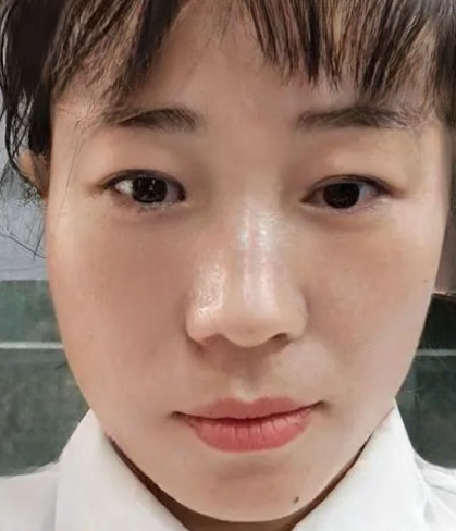 去眼袋手术