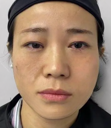 去眼袋手术