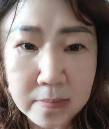 去眼袋手术