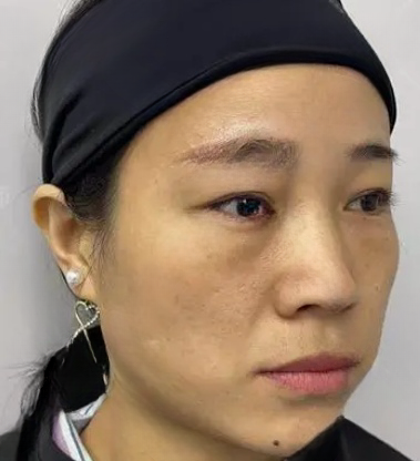 去眼袋手术