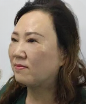去眼袋手术