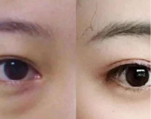 去眼袋手术