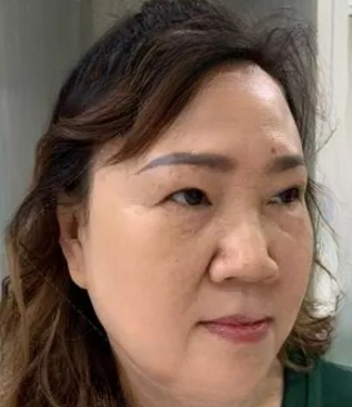 去眼袋手术
