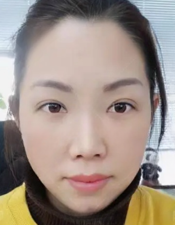 去眼袋手术