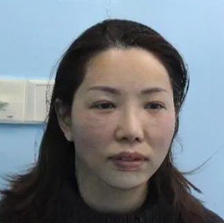 去眼袋手术