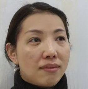 去眼袋手术