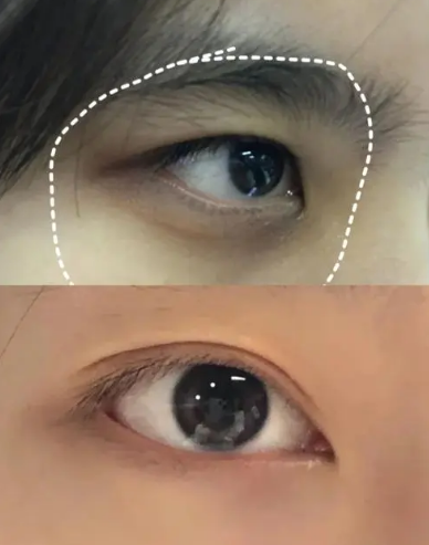 去眼袋手术