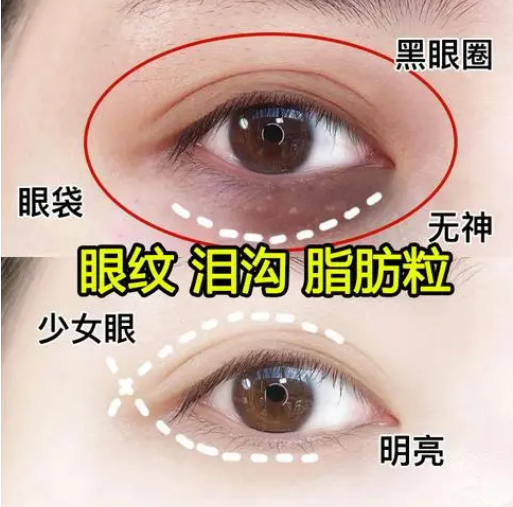 去眼袋手术