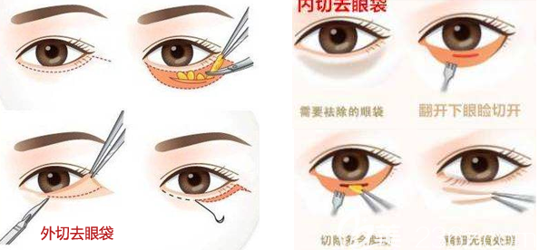 去眼袋手术