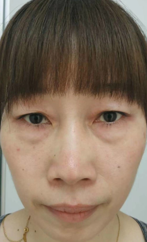 眼袋