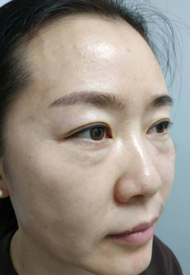 眼袋