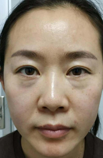 眼袋