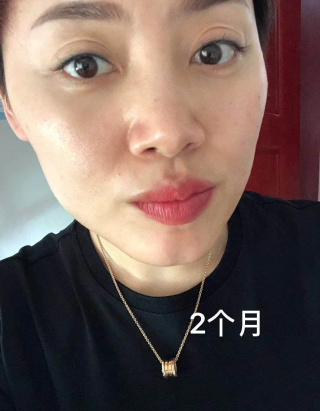 眼袋