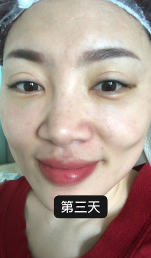 眼袋