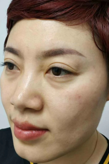 眼袋
