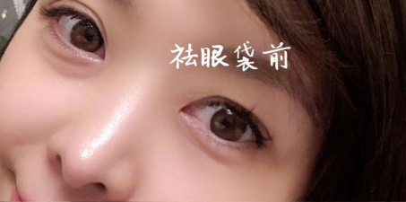 眼袋
