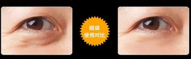 眼袋