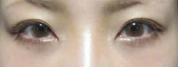 眼袋