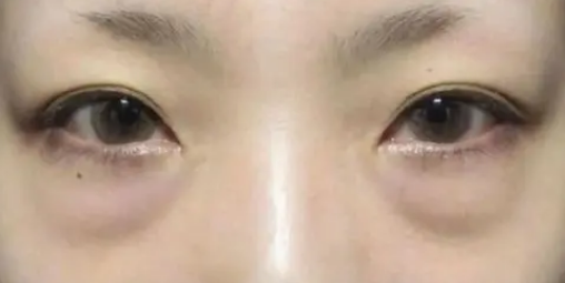 眼袋