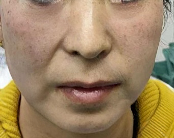去眼袋手术