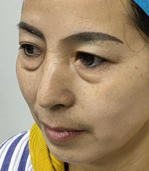 去眼袋手术