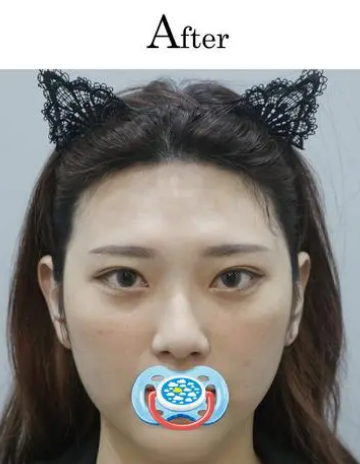 眼袋