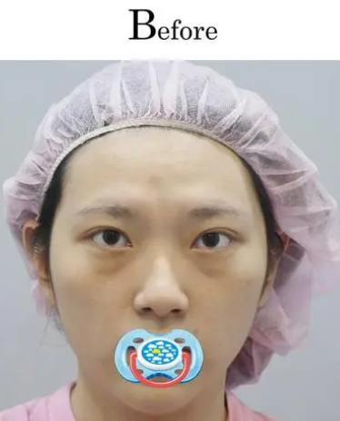 眼袋