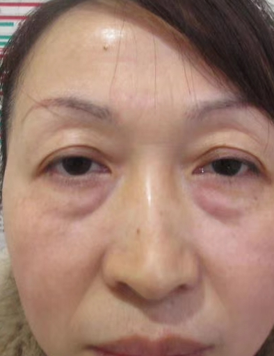眼袋