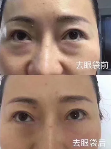眼袋