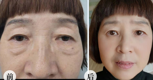 去眼袋手术