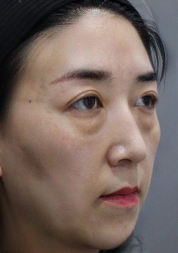去眼袋手术