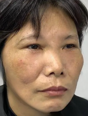 去眼袋手术