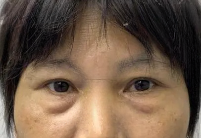 去眼袋手术
