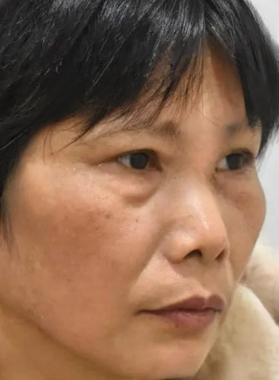 去眼袋手术