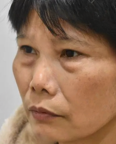 去眼袋手术