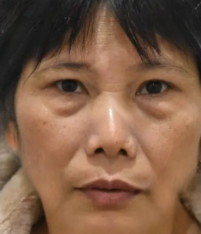 去眼袋手术